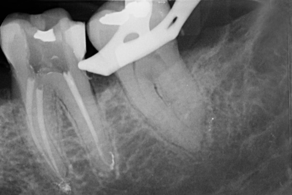 Endodontiste Saint Malo